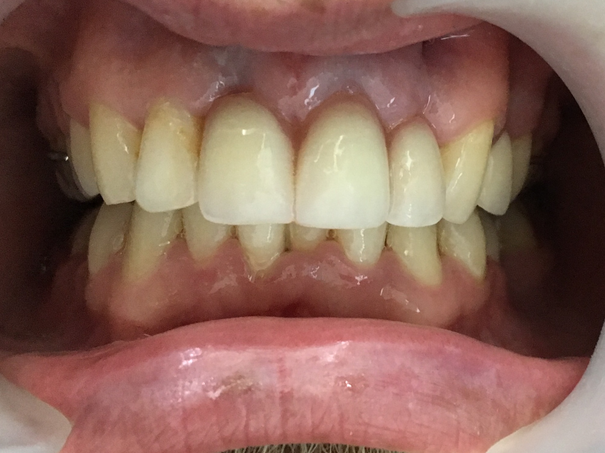 Review Implant Bangkok Dental Dentist Clinic By Bangkok Smile Dental 